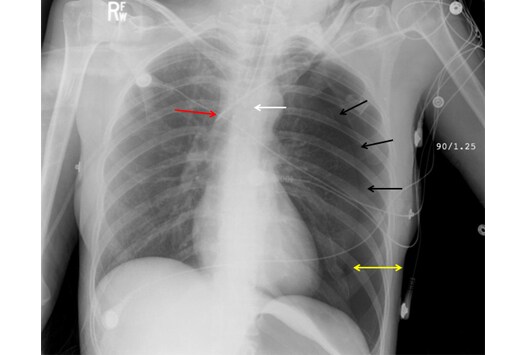 Subclavian Central Line Placement